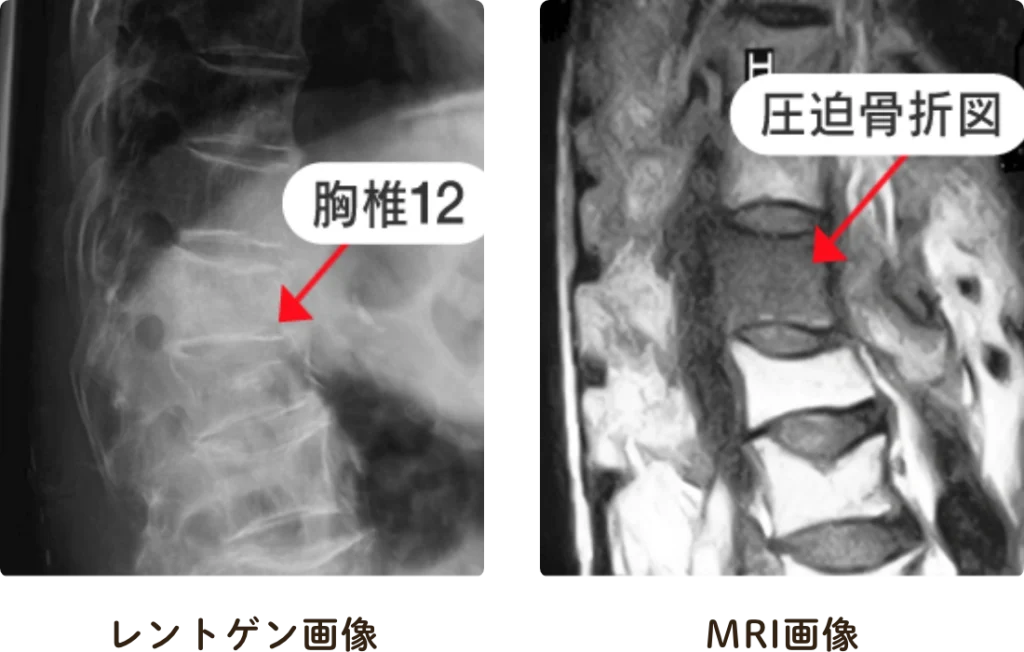 脊椎圧迫骨折